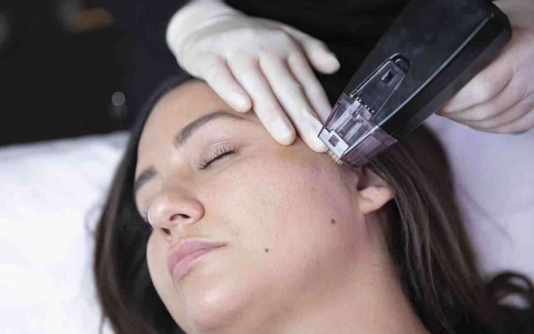 Morpheus8: The Magic Number of Sessions for Optimal Glow