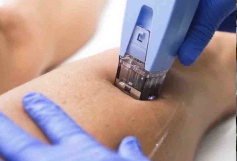 How Much Does Morpheus8 Cost? Your Price Guide to Skin Rejuvenation