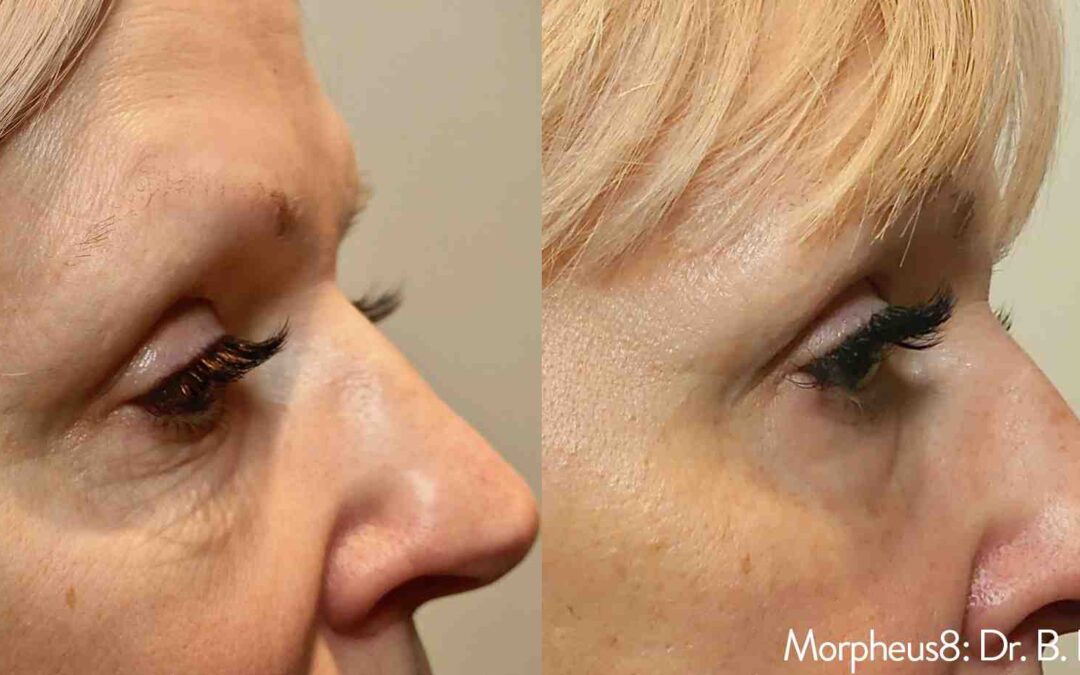 Morpheus8 for Eyes: Real Results, Real Transformations