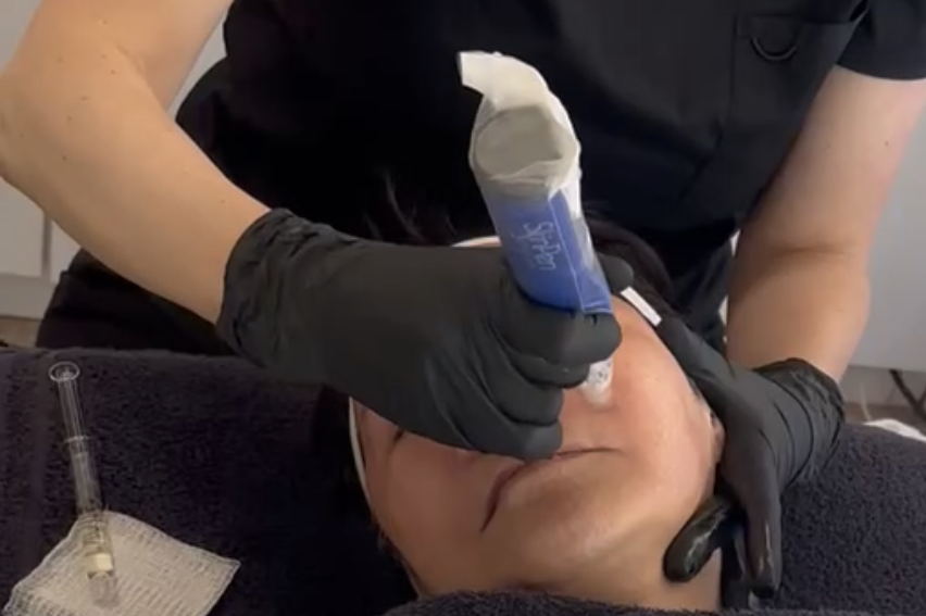 Beyond the Buzz: The Truth About Clinical Microneedling for Flawless Skin